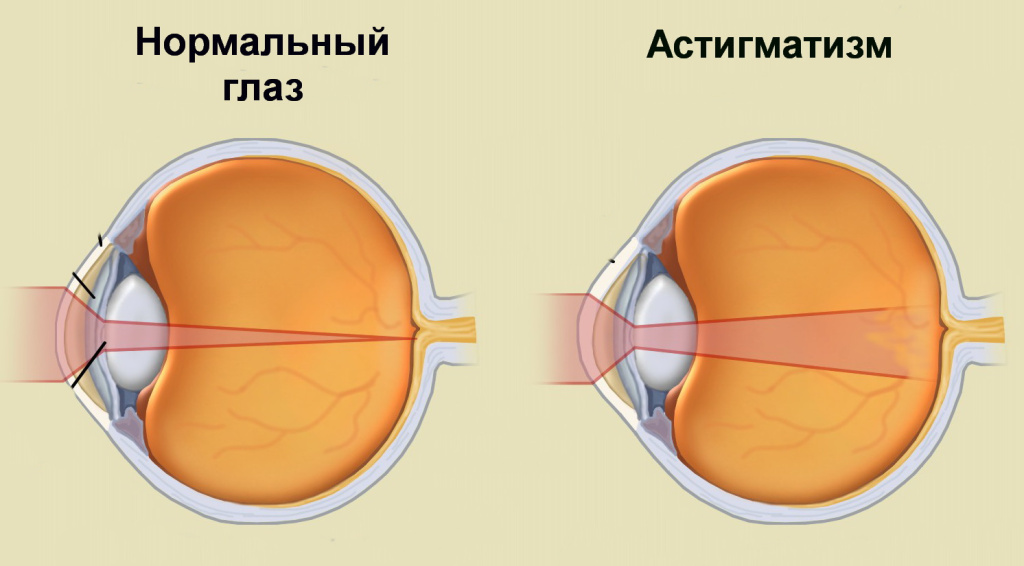 astigmatizm.jpg