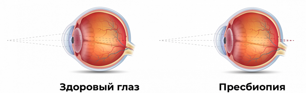 Схема возникновения пресбиопии E98851C9-08BA-4BD9-B60C-D0D1C1E134B1-1536x468.png
