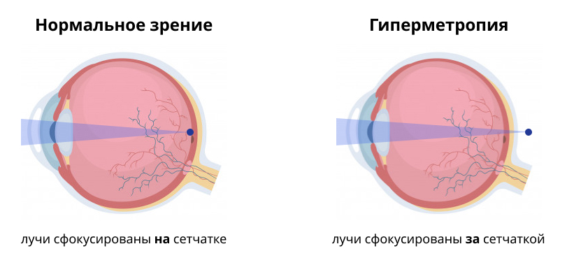 hypermetropia.jpg hypermetropia.jpg